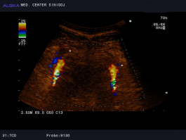 Ultrazvok možganskih žil - vertebralni arteriji, normalen izvid 2